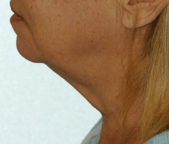 Chin Augmentation Results Fort Lauderdale