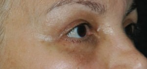 Eyelid Lift (Upper & Lower)