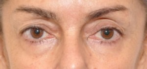 Eyelid Lift (Upper & Lower)