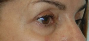 Eyelid Lift (Upper & Lower)