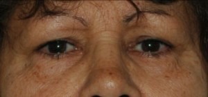 Eyelid Lift (Upper & Lower)