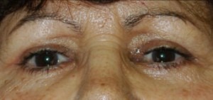 Eyelid Lift (Upper & Lower)