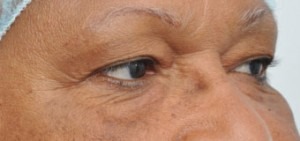 Eyelid Lift (Upper & Lower)