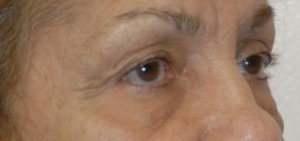 Eyelid Lift (Upper & Lower)