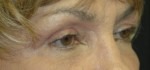 Eyelid Lift (Upper & Lower)