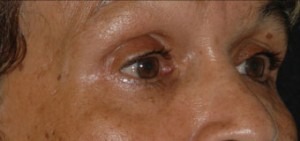 Eyelid Lift (Upper & Lower)