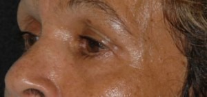 Eyelid Lift (Upper & Lower)