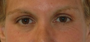 Eyelid Lift (Upper & Lower)