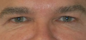 Eyelid Lift (Upper & Lower)