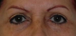 Eye Brow & Forehead Enhancement