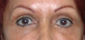 Eye Brow & Forehead Enhancement