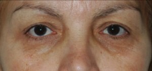 Eye Brow & Forehead Enhancement