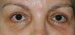 Eye Brow & Forehead Enhancement