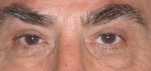 Eye Brow & Forehead Enhancement