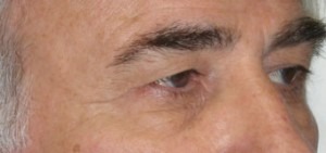 Eye Brow & Forehead Enhancement