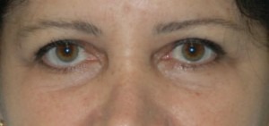 Eye Brow & Forehead Enhancement