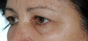 Eye Brow & Forehead Enhancement