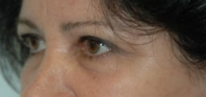 Eye Brow & Forehead Enhancement