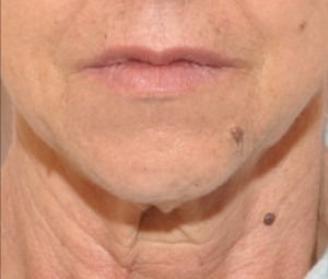 Face & Neck Rejuvenation