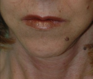 Face & Neck Rejuvenation