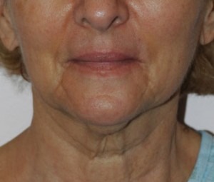 Face & Neck Rejuvenation