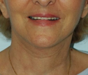 Face & Neck Rejuvenation