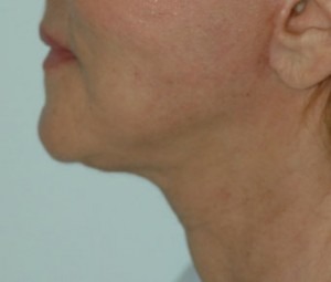 Face & Neck Rejuvenation