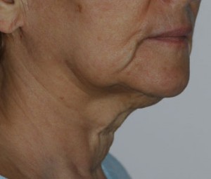 Face & Neck Rejuvenation