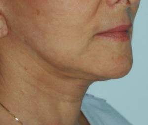 Face & Neck Rejuvenation