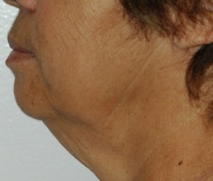 Face & Neck Rejuvenation