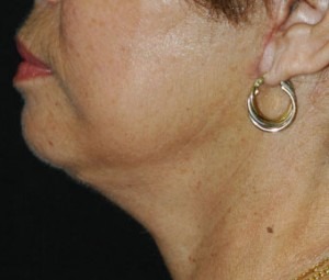 Face & Neck Rejuvenation