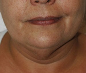 Face & Neck Rejuvenation