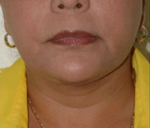 Face & Neck Rejuvenation