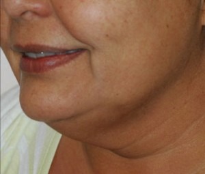 Face & Neck Rejuvenation