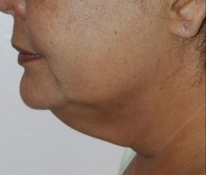 Face & Neck Rejuvenation