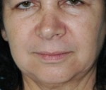 Face & Neck Rejuvenation