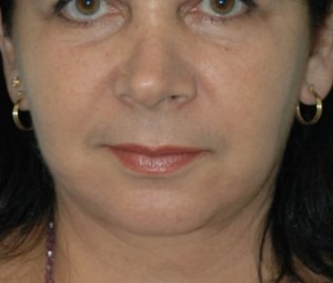 Face & Neck Rejuvenation