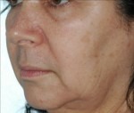 Face & Neck Rejuvenation