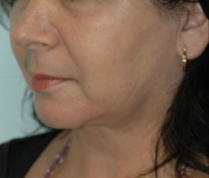 Face & Neck Rejuvenation