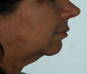 Face & Neck Rejuvenation