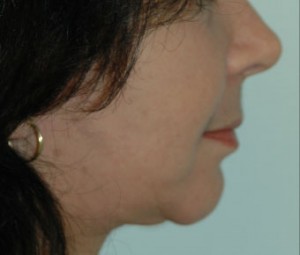 Face & Neck Rejuvenation