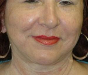 Face & Neck Rejuvenation