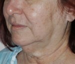 Face & Neck Rejuvenation