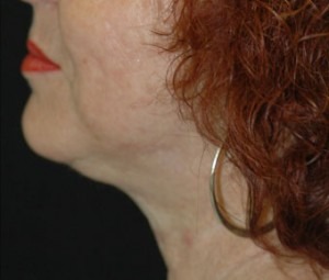 Face & Neck Rejuvenation