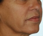 Face & Neck Rejuvenation