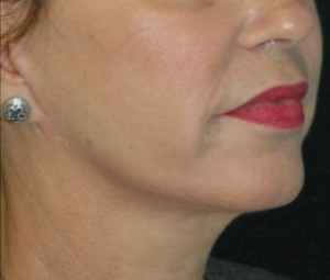 Face & Neck Rejuvenation