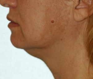 Face & Neck Rejuvenation