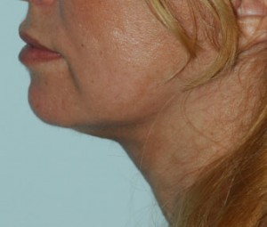 Face & Neck Rejuvenation