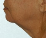 Face & Neck Rejuvenation