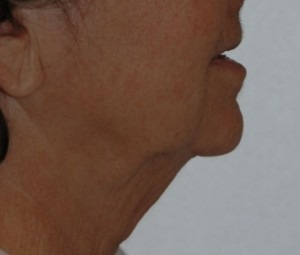 Face & Neck Rejuvenation